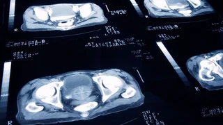 Prostate cancer treatment with fewer side effects 'as effective as radiotherapy'