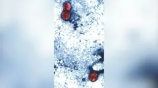 US reports first two deaths linked to parasitic infection outbreak