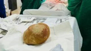 Doctors remove record-size bladder stone